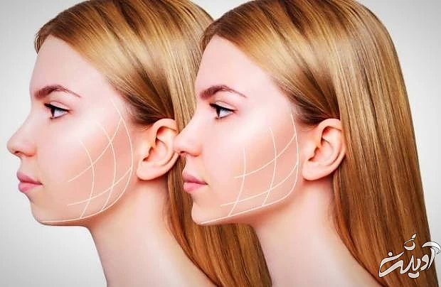 عمل زیبایی بیچکتومی